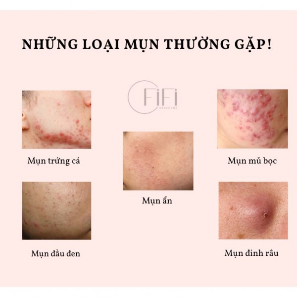 Xác định những loại mụn thường gặp ?