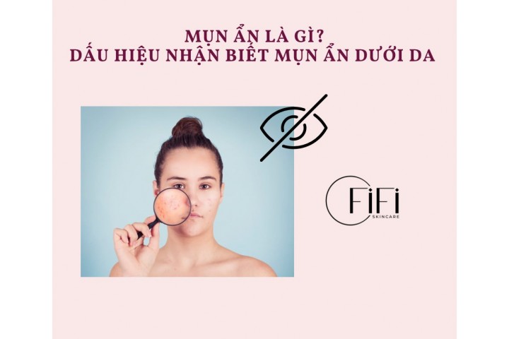 Mụn ẩn là gì? Dấu hiệu nhận biết mụn ẩn dưới da