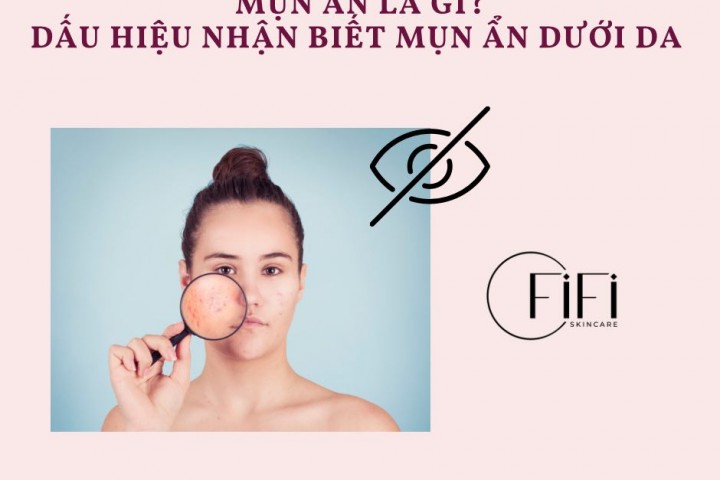 Mụn ẩn là gì? Dấu hiệu nhận biết mụn ẩn dưới da