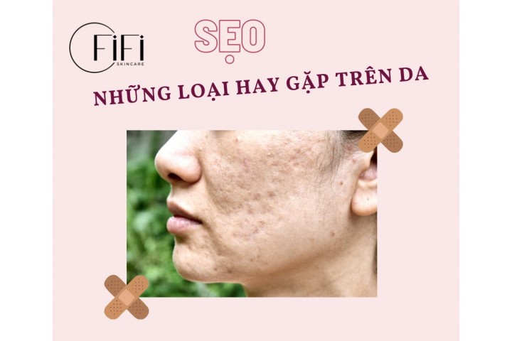 Một số loại sẹo hay gặp trên da