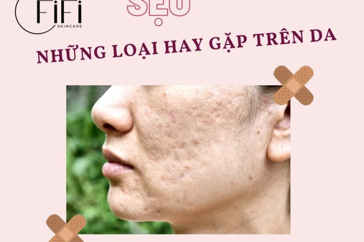 Một số loại sẹo hay gặp trên da