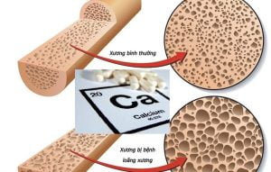 Tăng canxi - Tác dụng phụ của collagen